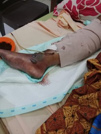 Pemuda Lubuk Linggau Jadi Korban Tabrak Lari, Kaki Harus Diamputasi